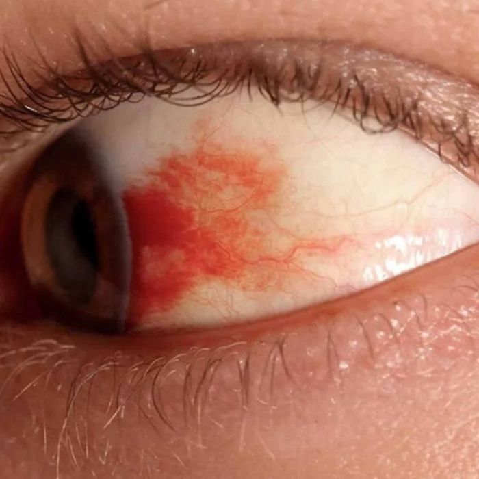 UNAM desarrolla gotas oftálmicas basadas en la vasoinhibina para tratar la retinopatía diabética